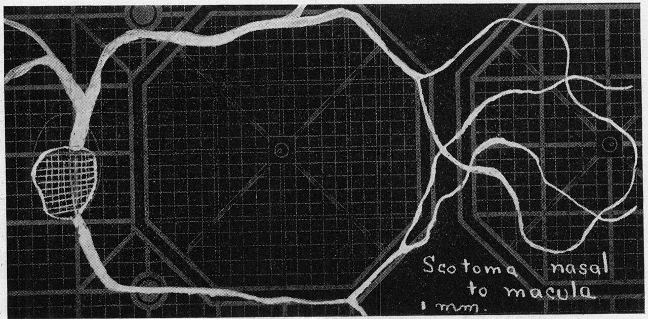 Rétinoscope Digital